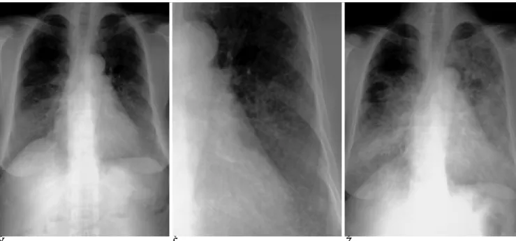 Fig. 3. A 49-year-old man with miliary tuberculosis who developed acute respiratory failure