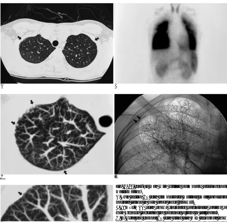 Fig. 1. 21-year-old man with diffuse pulmonary arteriovenous malformation.