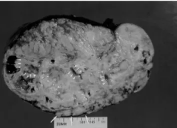 Fig. 1. A. Non-enhanced CT shows a well-circumscribed, lobulated, large hypodense mass with inner hyperdense strands (small white arrows) and focal calcifications (open arrowheads) in the left upper quadrant of abdomen.