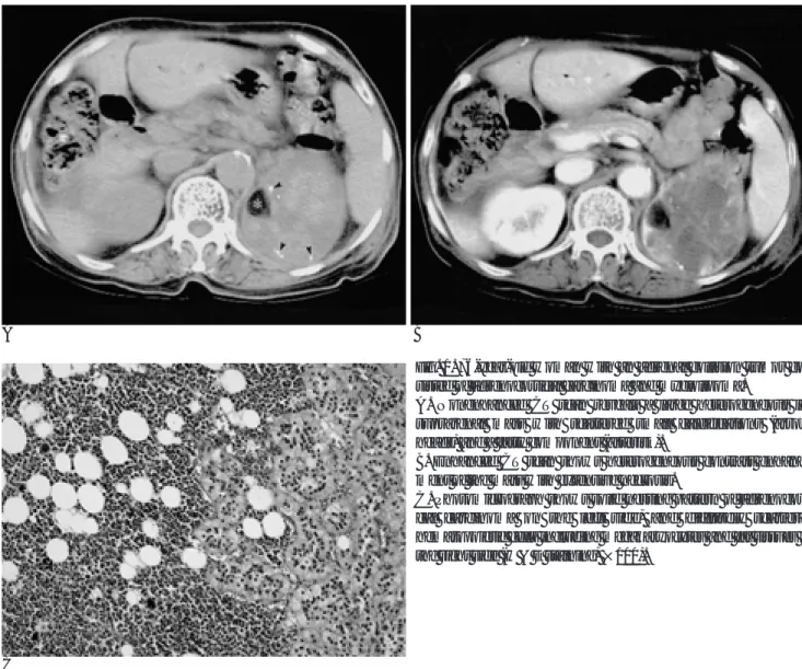 Fig. 1. 76-year-old woman with an adrenal collision tumor con- con-sisted of adrenocortical carcinoma and myelolipoma.