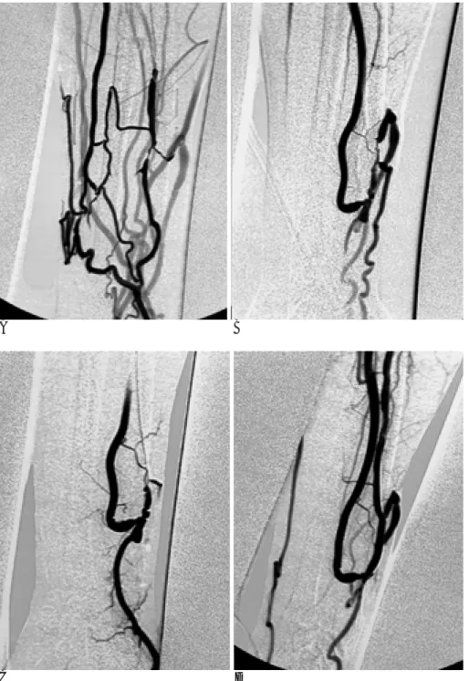 Fig. 1. A. Digital subtraction angiogram (DSA) obtained from retrograde venous approach shows multiple stenosis in venous limb of native AVF