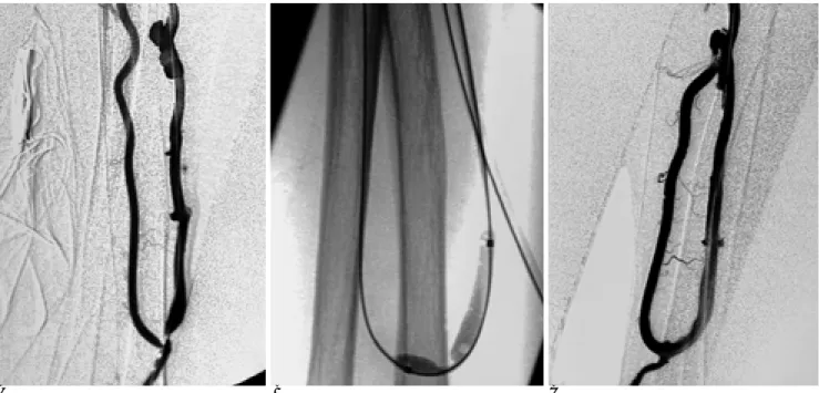 Fig. 3. A. Digital subtraction angiogram (DSA) shows two focal stenosis in proximal venous limb and anastomotic site of native AVF.