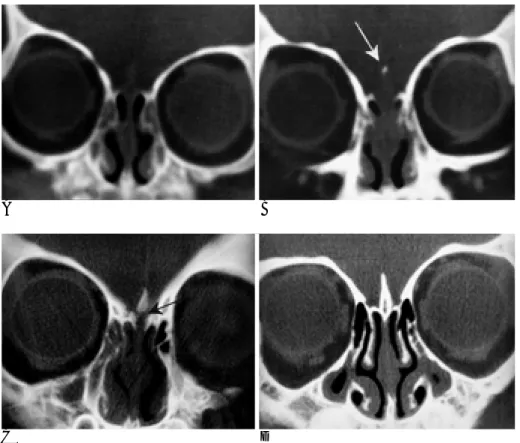 Fig. 2. Ossification of the perpendicular plate.