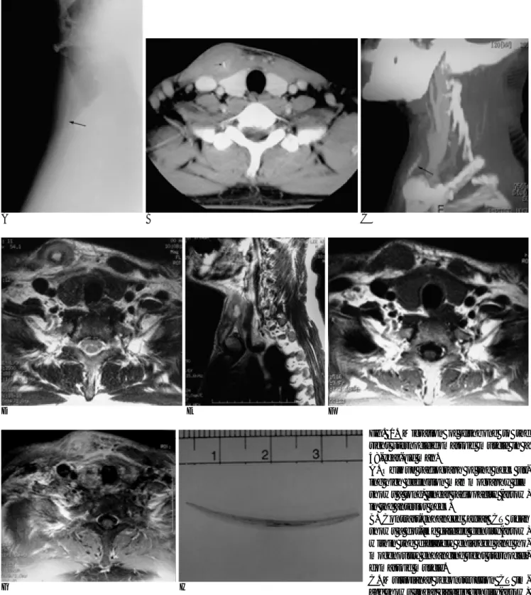Fig. 1. Migration of fishbone to the right sternocleidomastoid muscle in a 48-year-old man.