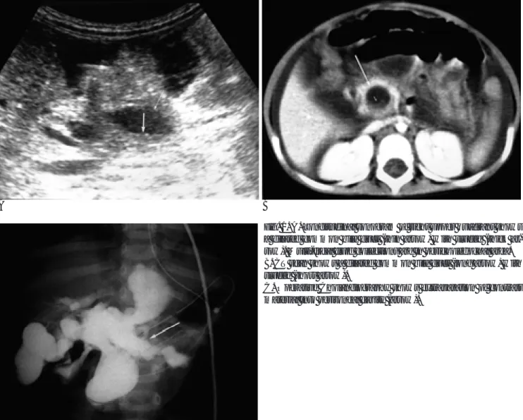 Fig. 1. A. Longitudinal sonogram of right upper quadrant shows a dilated common bile duct (thin arrow) with sludge (thick  ar-row)