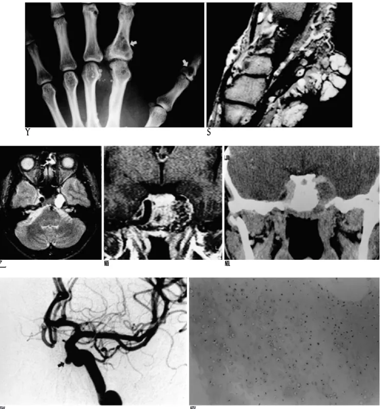 Fig. 1. A 32-year-old male with multiple soft tissue masses in the left hand and foot, headache, and diplopia at the lateral gaze.