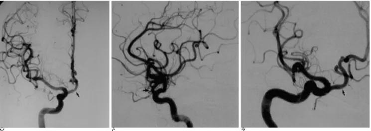 Fig. 2. Left internal carotid arteriogram reveals a broad-based saccular aneurysm at the main division of the middle cerebral artery