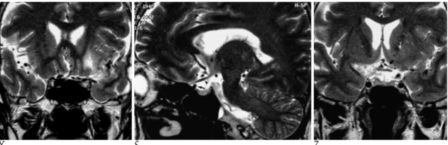 Fig. 4. T2-weighted coronal (A) and oblique sagittal (B) magnetic resonance images show an anomalous anterior cerebral artery (ar- (ar-rows) passes below ipsilateral optic nerve (arrowheads) and ascends superiorly between bilateral optic nerves to join the