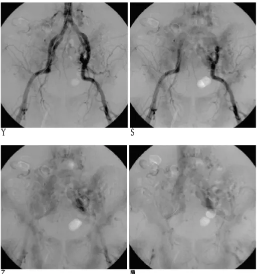 Fig. 1. A. Initial chest PA shows cardiomegaly and diffuse consolidation in both central lungs.