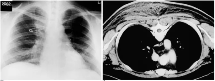 Fig. 7. A 25-year-old man with cellulitis in posterior chest wall. 
