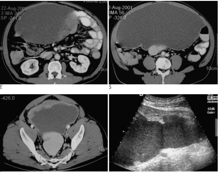 Fig. 1. A 58-year-old man with a 27.5×15.0×25 cm huge mass in abdominal cavity.