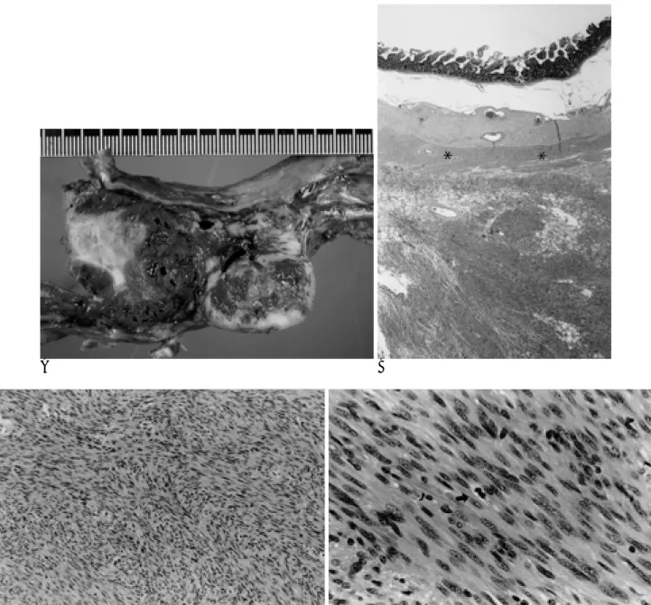 Fig. 2. A. Cut section shows a large hemorrhagic tumor mainly located in the mesenteric portion of the jejunum, which seems to be simply attached to the jejunal wall with no obvious extension.