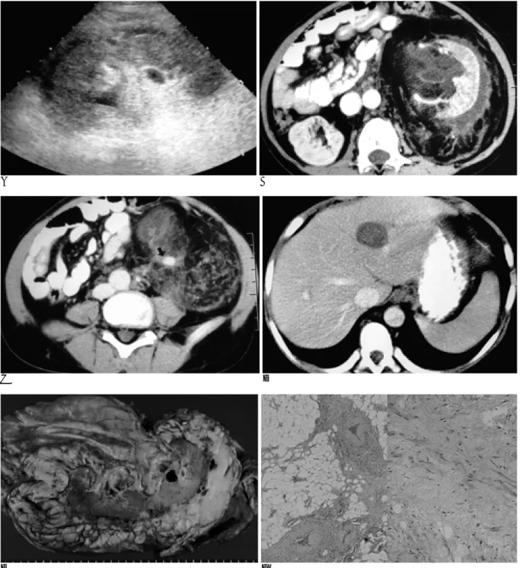 Fig. 1. Perinephric AML in a 13-year-old boy. 