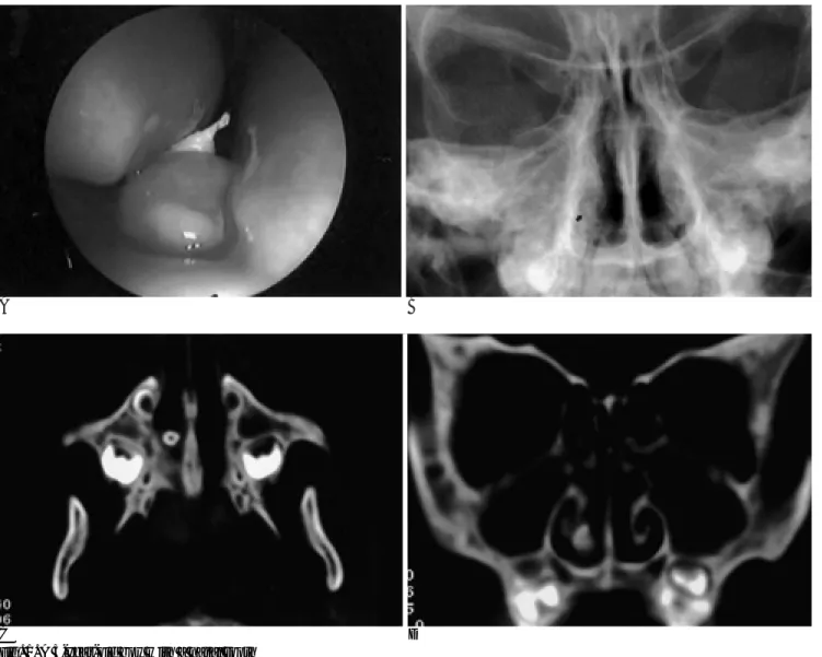 Fig. 1. A 5-year-old boy with a nasal tooth
