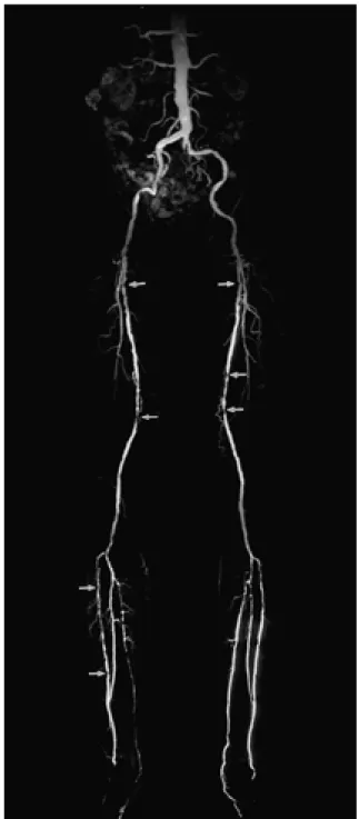 Fig. 1. Contrast-enhanced MR angiogram obtained in a 68- 68-year-old male with intermittent claudication.