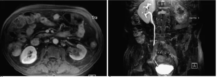 Fig. 3. A 78-year old man with a transitional cell carcinoma in the left kidney.