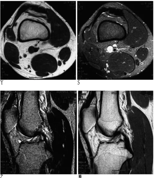 Fig. 1. A 21 year-old-man with bipartite patella.