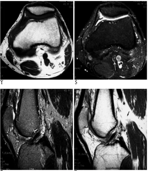 Fig. 3. A 43-year-old-man with patella contusion.