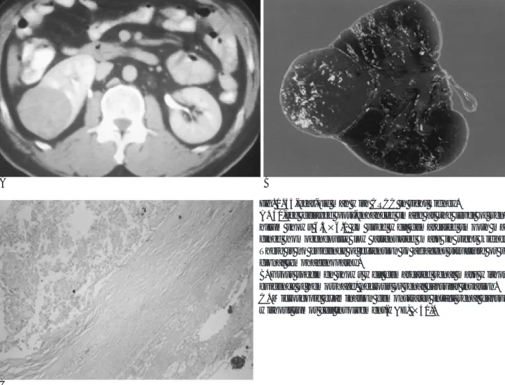 Fig. 1. 53-year-old man with CRCC in right kidney.