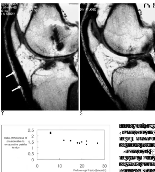 Fig. 2. Postoperative patellar tendon (arrows) on mid-portion shows more thicker (A) than contralateral normal patellar tendon (B) on T1 weighted  sag-ittal images.