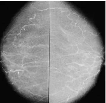 Table 1. Frequency of Breast Arterial Calcification by Age Distri- Distri-bution (p<0.05)