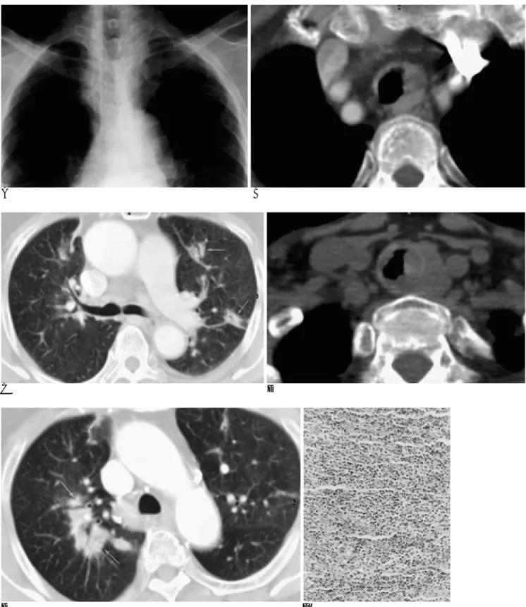 Fig. 1. A. Chest radiograph shows smooth indentation of the left wall of the trachea.