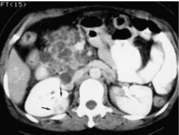Fig. 1. Contrast-enhanced CT scan shows a 2 cm sized solid mass (arrows) on right kidney