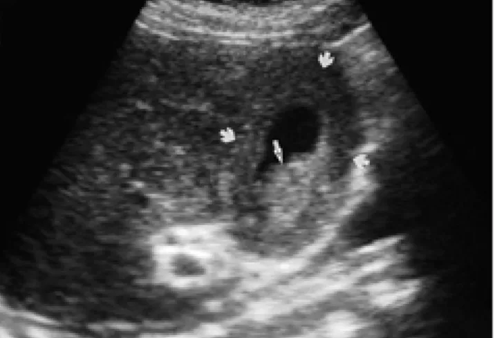 Fig. 3. Resected specimen of the gallbladder shows diffuse thickening of the gallbladder wall replaced by fleshy and whitish tumor tissue.