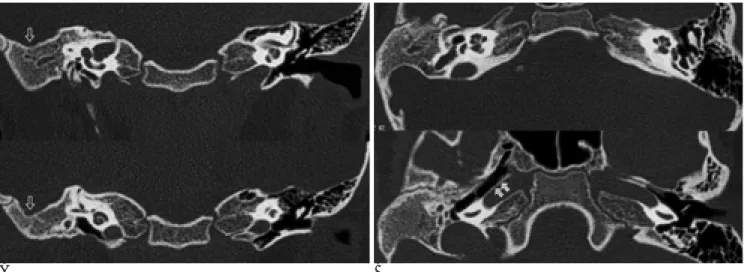 Fig. 2. A five-year-old girl with bilateral EAC atresia.