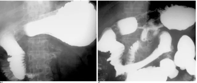 Fig. 1. Patient 4. 49-year-old woman with retroperitoneal lymph node metastases from uterine cervical carcinoma.