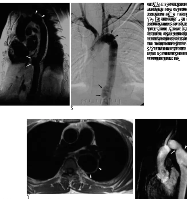 Fig. 2. Two aortic aneurysms in a 34- 34-year-old man who sustained blunt  tho-racic trauma 13 months ago.