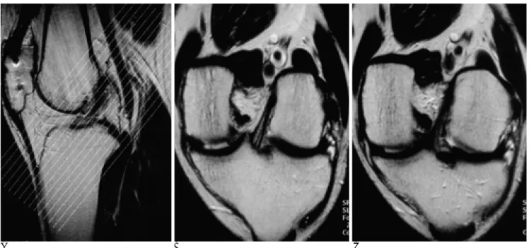 Table 1. Comparison of Complete Tear &amp; Partial Tear of ACL on Conventional MR Imaging