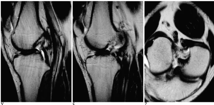 Fig. 3. A 29-year-old woman with partial ACL tear.