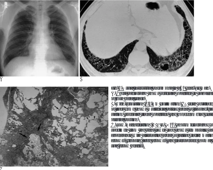 Fig. 1. Usual interstitial pneumonia in a 61 year-old man.