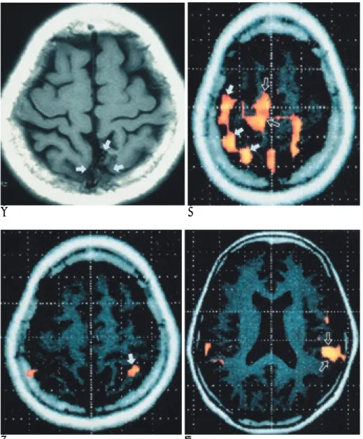 Fig. 3. Functional MR images of the patients with arteriovenous  malforma-tion in left fronto-parietal lobe during motor and sensory stimuli.