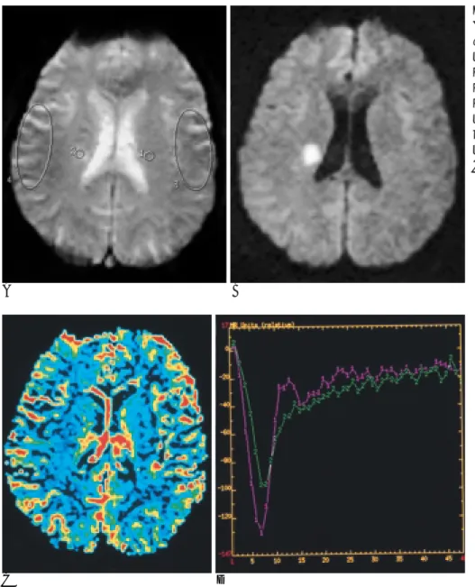 Fig. 1. 49-year-old man with dysarthria (case 1).