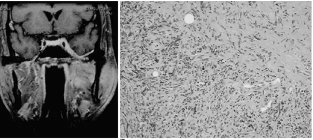 Fig. 3. D. Gd-enhanced T1-weighted coronal MR image shows a bulging of the left cavernous sinus with strong enhancement of ad- ad-jacent dura (black arrow).