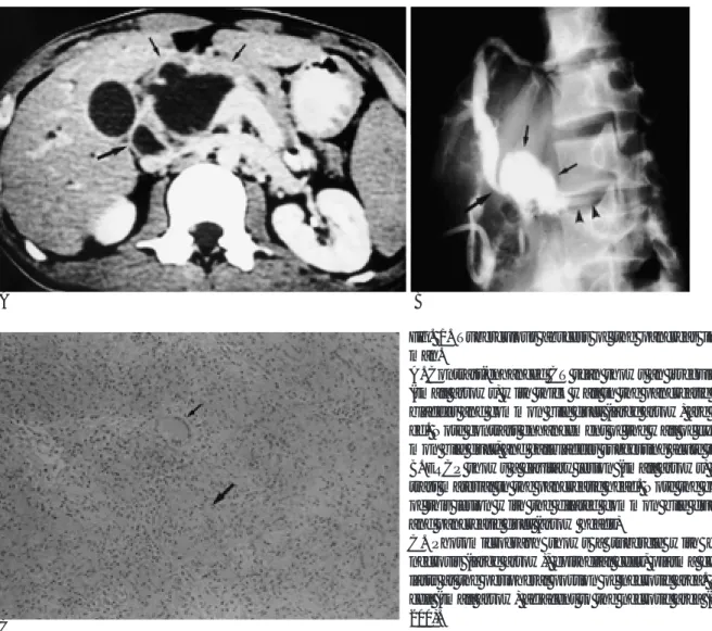 Fig. 1. Tuberculous abscess of the pancreas in a 28-year-old man.