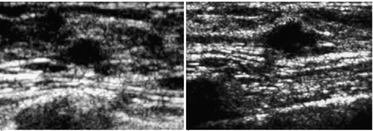 Fig. 2. 50-year-old woman was found to have suspicious microcalcification on screening mammogram (A)