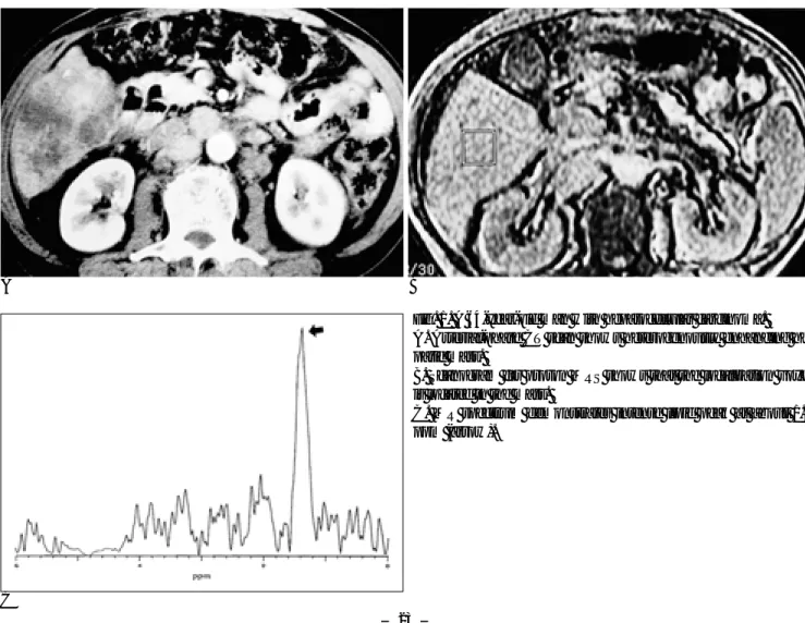 Fig. 1. A 64-year-old man with hepatocellular carcinoma. 