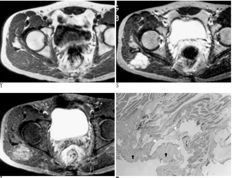 Fig. 1. Typical form of venous malformation