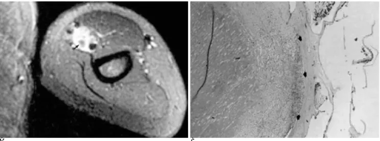 Fig. 2. Venous malformation with thrombosis.