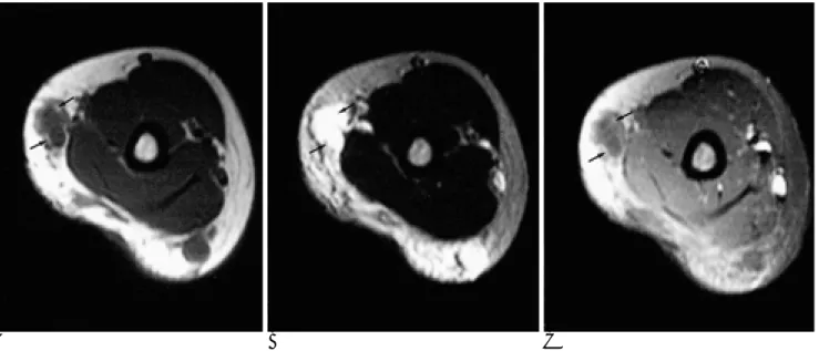 Fig. 4. Typical form of lymphatic malformation.