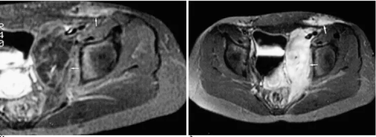 Fig. 6. Lymphatic malformation with delayed enhancement of the cystic portion.