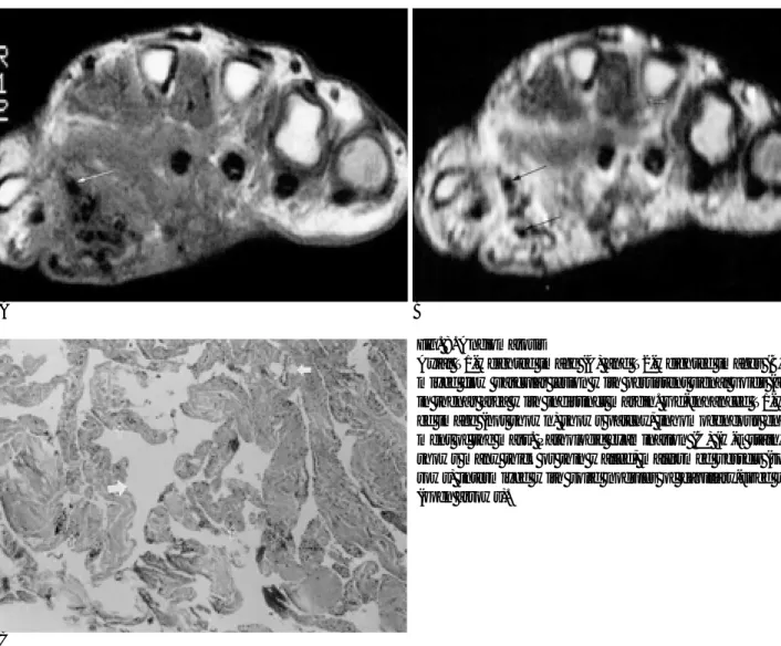 Fig. 8. Angiomatosis