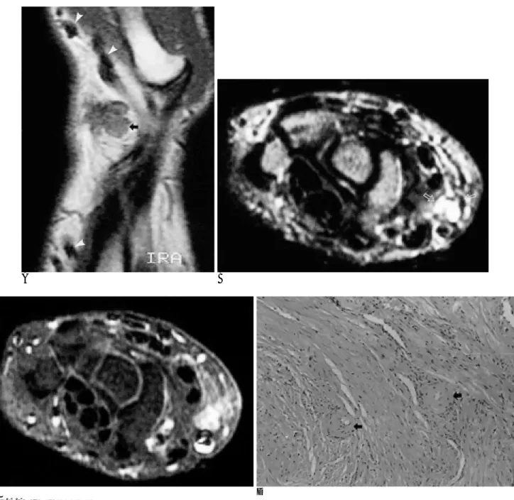 Fig. 9. Angioleiomyoma