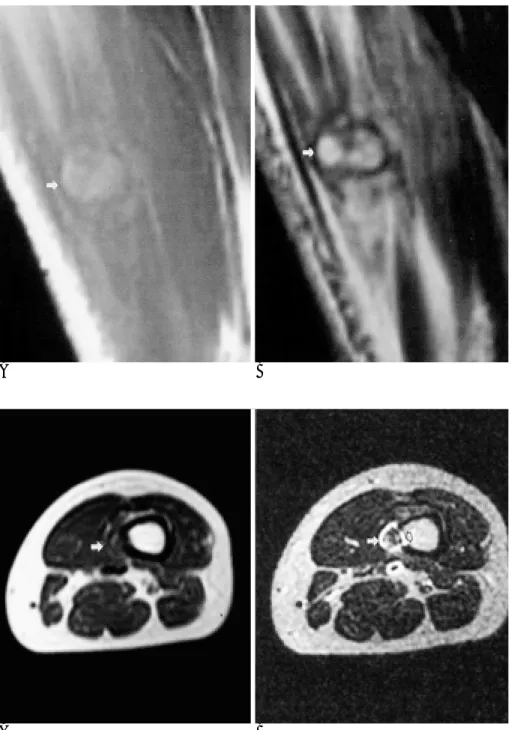 Fig. 10. Organizing hematoma.