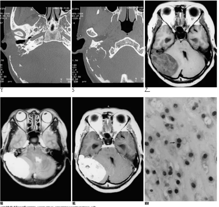 Fig. 1. 50-year-old female with myxoid chondrosarcoma. 