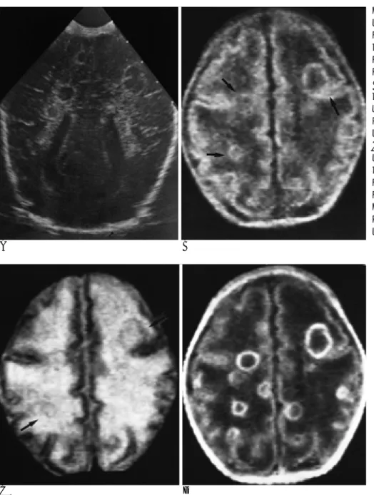 Fig. 1. A. Coronal brain sonography shows multiple ring-like lesions of low echoic