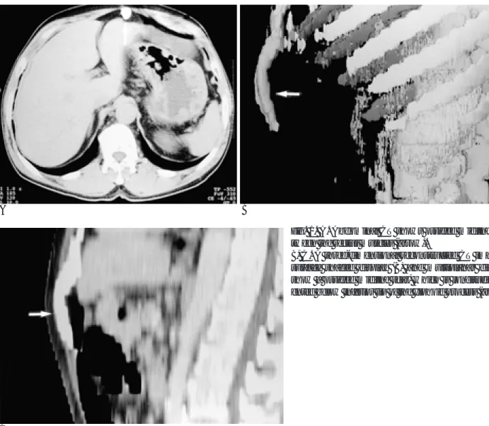 Fig. 1. A. Abdominal CT shows ossified midline scar be- be-tween the rectus muscles (arrow).